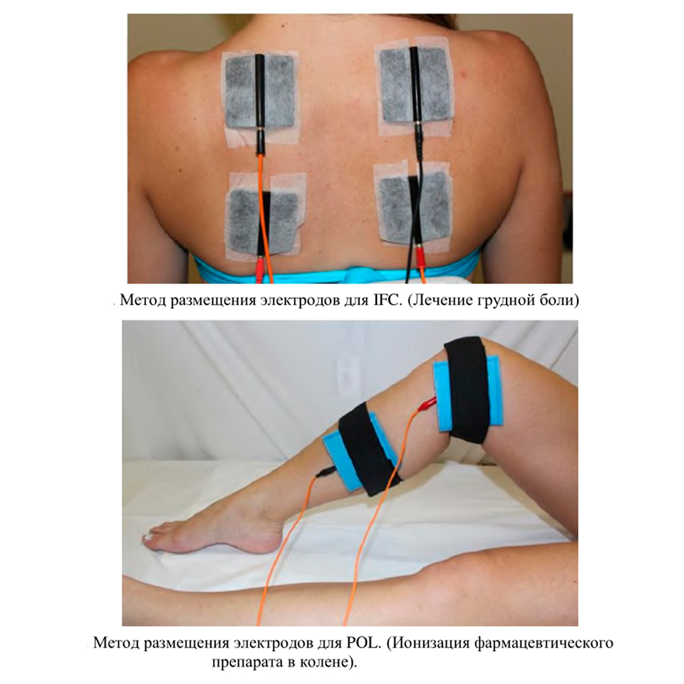 Аппарат для электротерапии и электростимуляции Ibramed Neurodyn фото6
